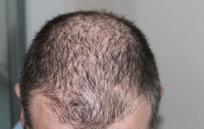 Hair loss