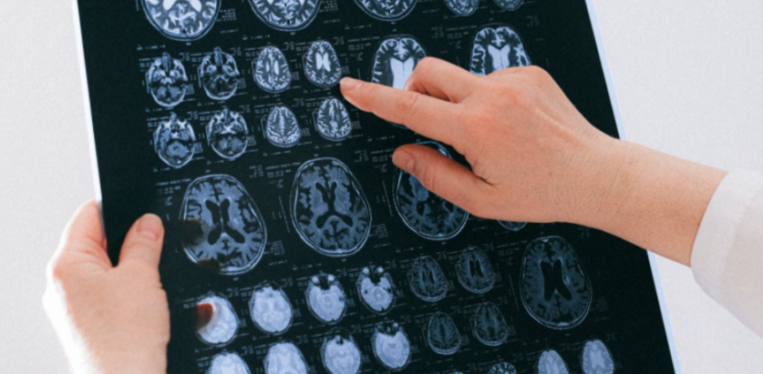 cerebral palsy rontgen